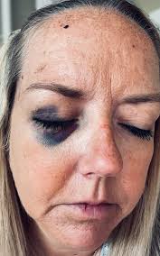 Should I see a doctor after a bad seizure?