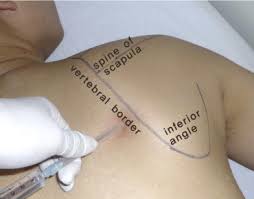 Image result for Scapulothoracic Injection