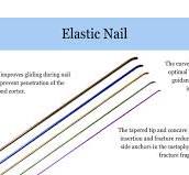 Titanium elastic nail is orthopedic implants used in surgery