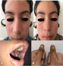 Pediatric Demodicosis Associated with Gain-of-Function Variant in STAT1  Presenting as Rosacea-Type Rash