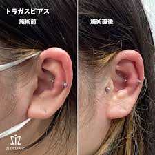 ピアス トラガス 痛い