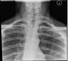 My X Ray December 2012 Hilary X