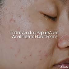 Image result for Papule