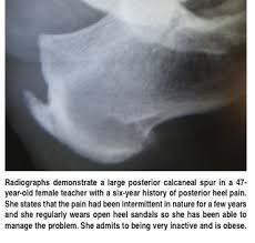 How To Conquer Achilles Insertional Calcific Tendinosis Podiatry Today