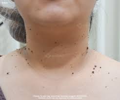 Image result for Skin Tag