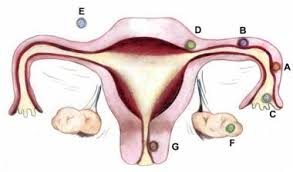Doctors call these tumour markers. Uterine Tube Fallopian Tube Anatomy Overview Pathophysiological Variants