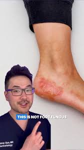 Image result for pompholyx soles of feet