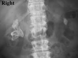 Struvite And Staghorn Calculi Background History Of The Procedure Problem Staghorn Calculus Renal Calculi Renal