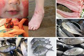 Terima kasih telah membaca kompas.com. 5 Jenis Ikan Paling Gatal Dan Angin Pesakit Ekzema Wanita Bersalin Perlu Elak