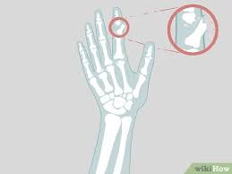 How to know if you have a serious knee injury. How To Determine If A Finger Is Broken With Pictures Wikihow