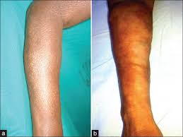 Eosinophilic Fasciitis Bindevevssykdommer Nobindevevssykdommer No