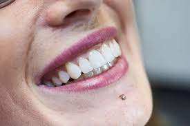 Ist ein effizientes praxistaugliches schonendes schienensystem für sanfte zahnkorrekturen. Aligner Schienen Die Unsichtbaren Zahnspangen Kieferorthopadie Dr Thomas Schnell