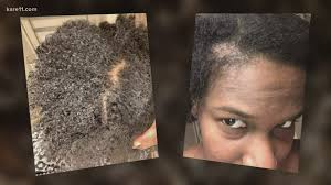 Can stress linked to COVID-19 lead to hair loss and balding?