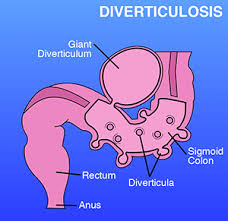 Image result for Diverticulitis