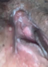 For example if you are taking antibiotics or any medicine that creates yeast. Does This Look Like Herpes Or Yeast Infection Sores Genital Herpes Simplex Forums Patient