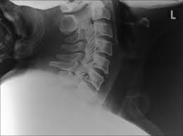 Here's what to expect with this painless procedure and why your dentist may recommend it. The Danger Of Failure To Recognize Injury In Cervical Spine X Ray For Trauma
