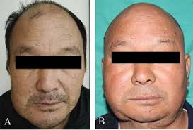 A. The preoperative front view; B. The postoperative front view 14...