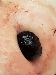 Image result for Rectal prolapse