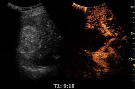 Where can i download hi res music for free and paid music sites? Contrast Enhanced Ultrasound Wikipedia