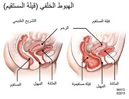 أعراض وأسباب الهبوط الخلفي أو قيلة المستقيم