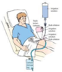 Image result for Continuous Bladder Irrigation