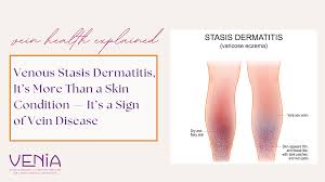 Image result for Stasis Dermatitis