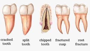 Root canal treatment to fix and spare a seriously harmed or contaminated tooth as opposed to evacuating it. Cracked Tooth Root Canal Reddit