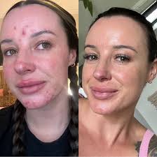 Some of my favourite skin transformations. Which one do you love?  #jennadeeskin #beforeandafterskin #northlakes #brisbane #northlakesbeauty  #northlakesskinclinic