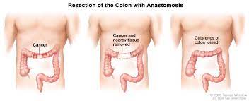 Colon cancer is one of the most common cancers in women. Colon Cancer Hematology Oncology Associates Of Cny