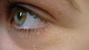 why we get those white skin spots cheek acne skin care white bump on eyelid