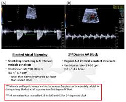 Cardiac Arrhythmias And Antiarrhythmic Drugs - Sciencedirect