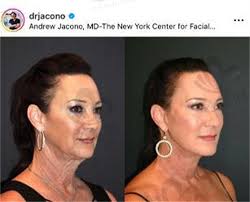 令欧美圈颜值回春的Dr.Andrew Jacono,拉皮手术一绝自然不变形持久性好_之美网