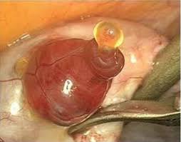Human egg | Muco cervical, Gravidez ectópica, Ervas