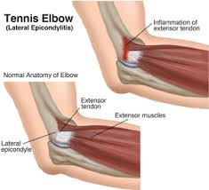 Related online courses on physioplus. Physical Therapy Guide To Tennis Elbow Lateral Epicondylitis Choosept Com