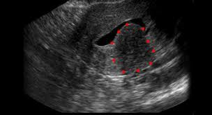 Das gebärmutterfibrom (oder myom) ist ein gutartiger tumor, der sich in der gebärmutter entwickelt. Myom Der Gebarmutter Uterusmyom
