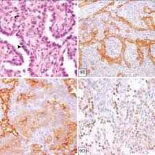 Pneumologie, chirurgie toracica, radiologie si imagistica, ecografie abdominala, imunomicrobiologie, bacteriologie, serviciu anatomie patologica si hematologie, laborator imunochimie si lavaj bronhoalveolar, sectie supraveghere epidemiologica a tuberculozei si. Constantin Ancuta Medical Doctor Institutul De Pneumoftiziologie Marius Nasta Bucharest Pneumologie