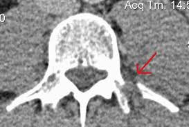 Maybe you would like to learn more about one of these? Transverse Process Archives Md Direct