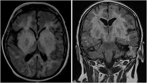 • restriction on diffusion weight mri = more sensitive than conventional sequences. A Case Of Herpes Simplex 2 Encephalitis With An Unusual Radiographic Manifestation Sciencedirect