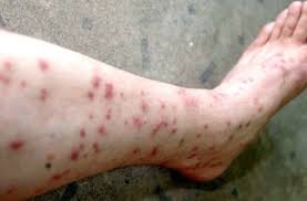 Can Fleas Live On Humans Metro News You know fleas can jump very far and high compared their sizes. can fleas live on humans metro news