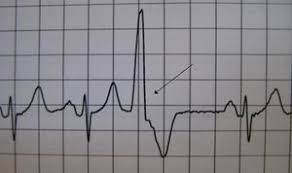 Pvcs are characterized by premature and bizarrely shaped qrs complexes that are unusually long (typically >120 msec) and appear wide on the electrocardiogram (ecg). Premature Ventricular Contraction Wikem