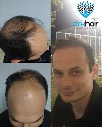Drkhair Lechenievypadeniyavolos Haartransplantation Dhimetod Hairtransplantationinturkey Germany England London Manchester Birmingham Russia Moscow