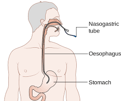 May 10, 2021 · nasogastric tubes are part of the standard of care in treating intestinal obstruction and can also be used to provide nutritional support. Nasogastric Ng Tube Placement Oxford Medical Education