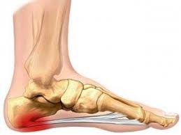 Mimedx Initiates Phase 3 Plantar Fasciitis Clinical Trial Running With Plantar Fasciitis What Is Plantar Fasciitis Plantar Fasciitis
