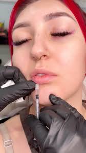 Slowly rebuilding this cutie’s lips, 1/2 syringe at a time after dissolving  old migrated filler in the summer. The lip flip is the cherry