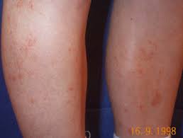 This can create purple spots on the skin that range in size from small dots to large patches. Capillaritis Dermnet Nz