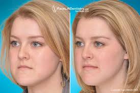 We did not find results for: Change The Shape Of Your Face Without Surgery