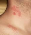 Maladies peau