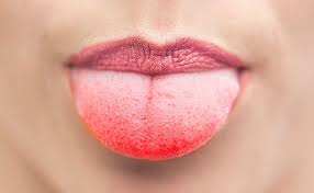 Check spelling or type a new query. Mundsoor Anzeichen Risiken Behandlung Der Mundfaule Dentalwissen