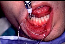 Image result for Periapical Block