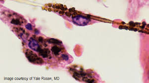 Hemangioma, hemangiopericytoma · hemangiosarcoma, angiosarcoma · lymph vessels, lymphangioma · lymphangiosarcoma. Usmle Rx Step 1 Qmax Challenge 1632 First Aid Team